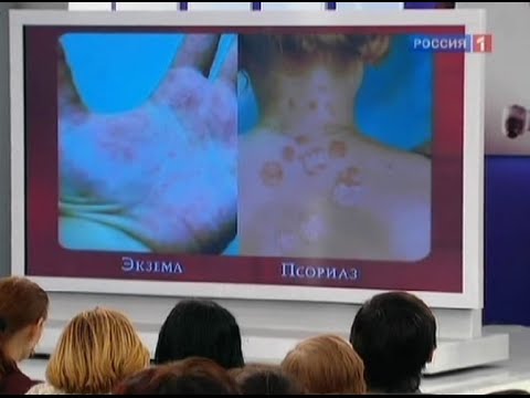 Eczema a kezén: hogyan kell kezelni, típusai és tünetei, a megfelelő gyógymódok