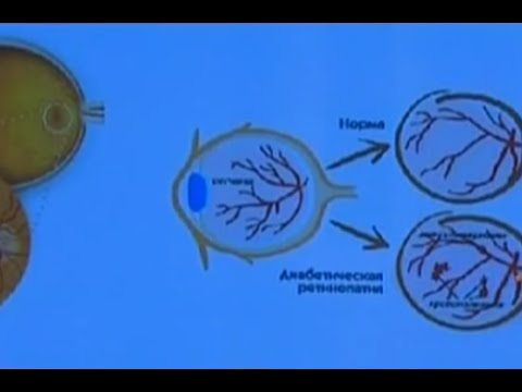 Déficience visuelle avec l'âge